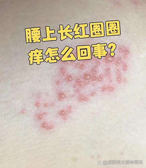 后背腰部痒的原因