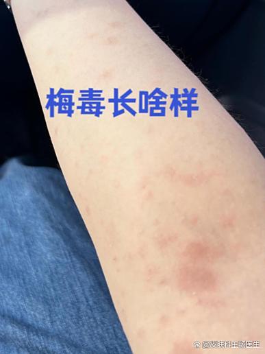怎样辨别是不是梅毒疹