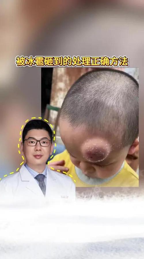 被冰块砸到脑袋怎么办