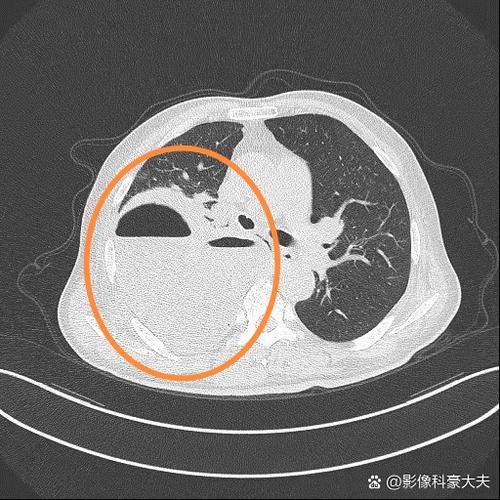 肺炎死亡病例讨论范文