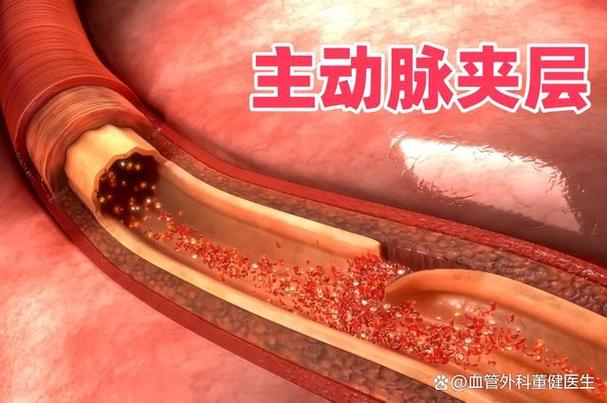 支架手术后注意事项