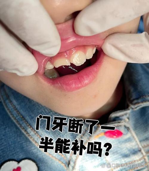 断掉的门牙能接好吗