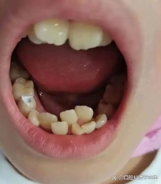 7岁孩子旧牙没掉长出新牙正常吗