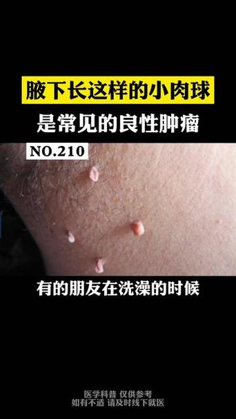 腋下长了个小肉揪揪是怎么回事