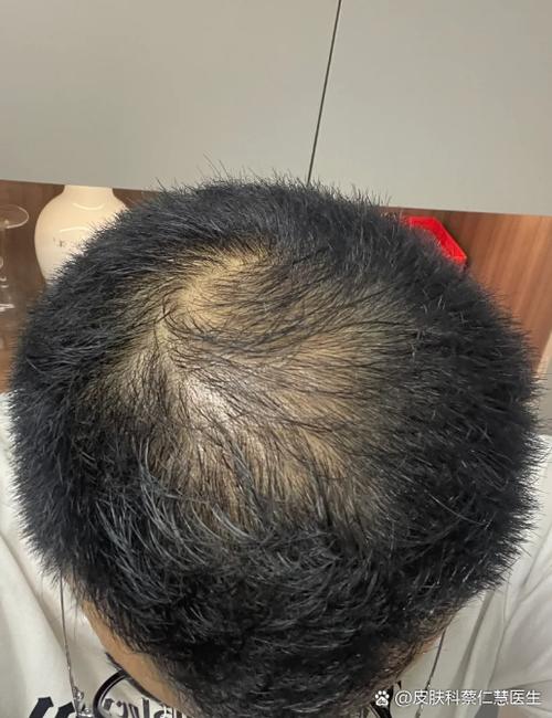 头发脱了还能再生吗