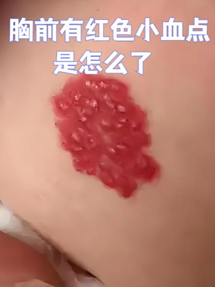 皮肤上有红色的小血点怎么回事