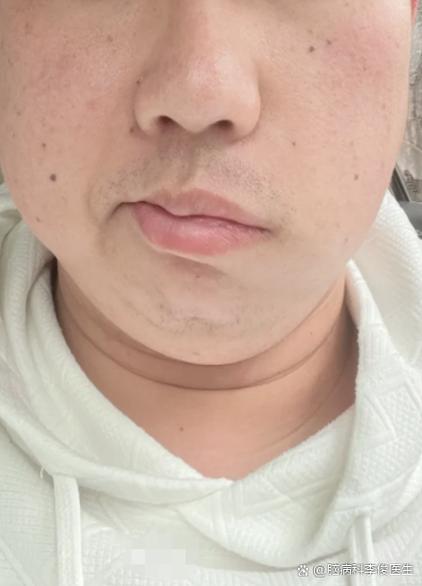 脸麻是什么原因