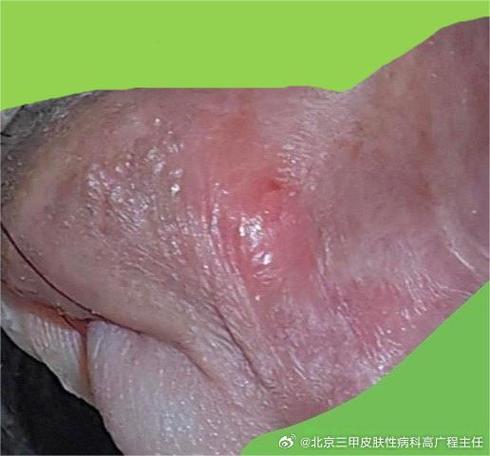 梅毒症状截图3