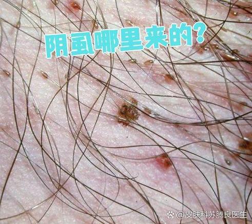 阴虱虫