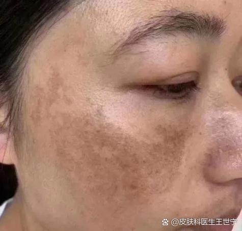 脸一晒就起斑怎么办