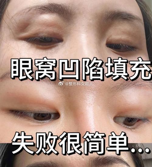 脂肪填充眼窝一年后图片