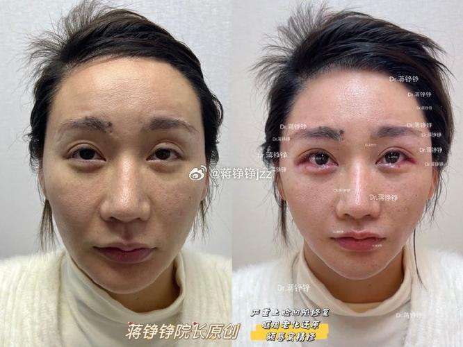 脂肪填充眼窝一年后图片截图2
