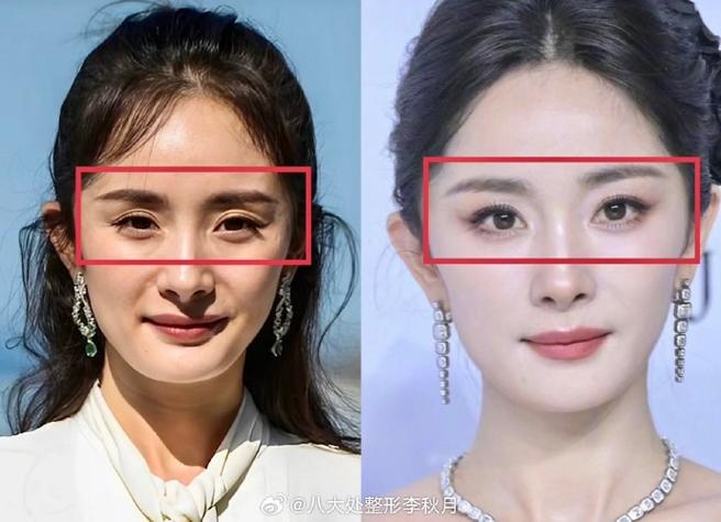脂肪填充眼窝一年后图片截图3