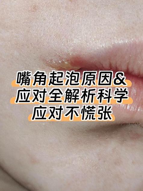 嘴角黑色素去除小妙招