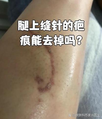 腿上有个大疤能去掉吗