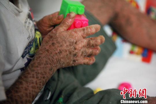 玉米男孩皮肤病图片