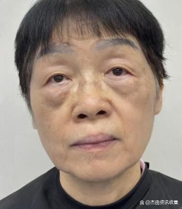 七十岁以上老人做眼袋