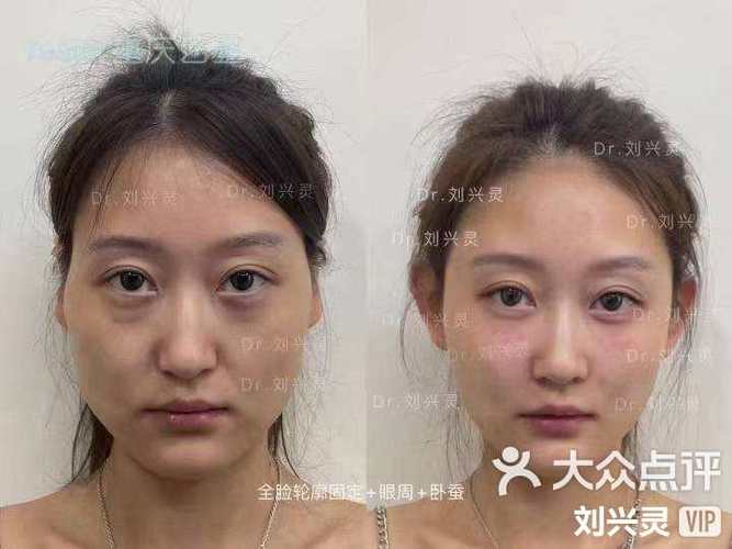 脸上打胶原蛋白好还是玻尿酸好