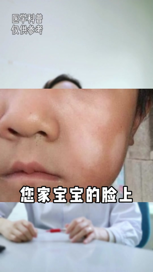 孩子脸上长了一小圈白色的