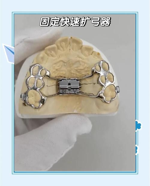 扩弓器怎么加力收紧视频