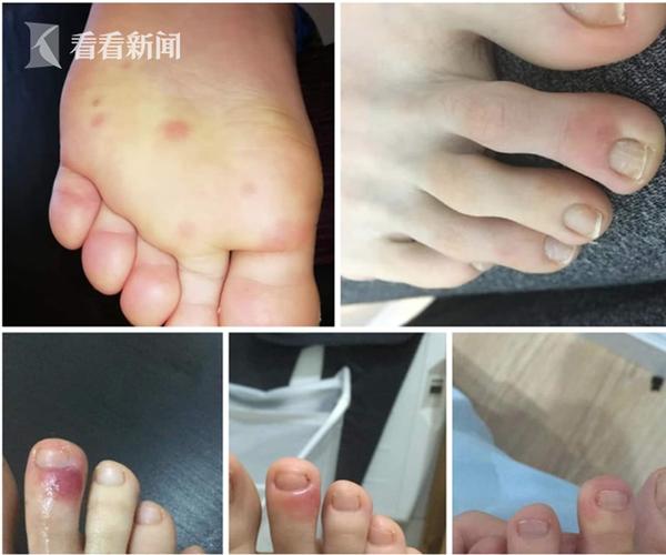 新冠肺炎初期症状
