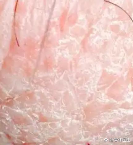 女性私处脱皮怎么回事啊