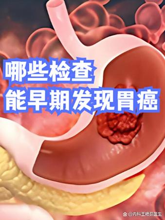 hp是胃癌早期症状吗