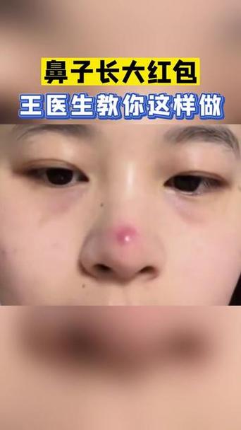 鼻头长痘红肿快速消除小妙招