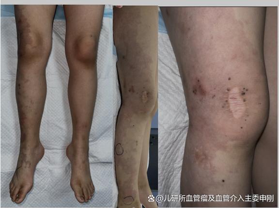 pdk是什么病