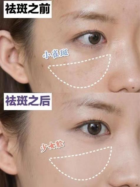 脸上淡斑最简单有效的方法