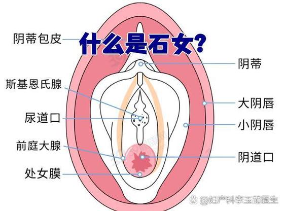 怎么判断是不是石女