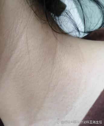 腋下黑痒是什么原因