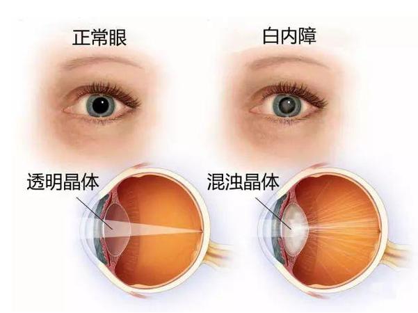 白内障眼睛图片真实照片