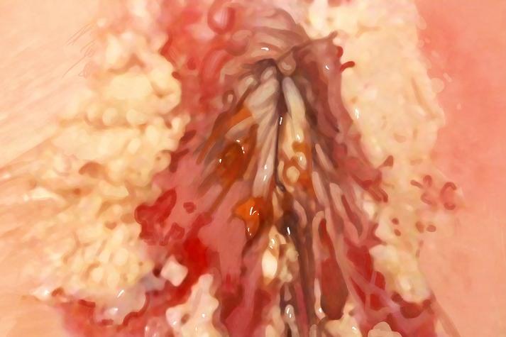 女性念珠菌感染症状