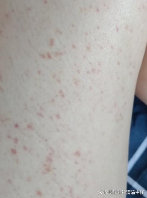 身上痒小红点截图3