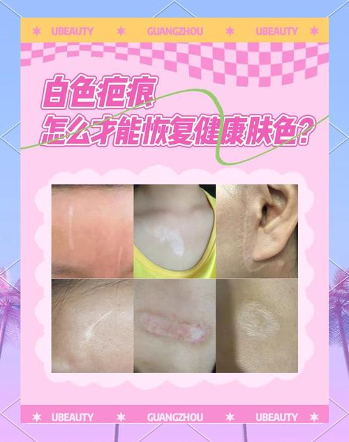 白色线状疤痕怎么去除