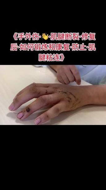 手腕肌腱恢复锻炼视频截图2