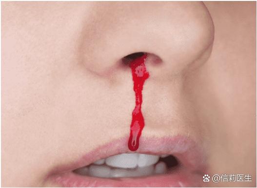 60岁突然流鼻血是什么病的前兆