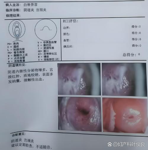 下面出现白色豆腐渣是怎么回事