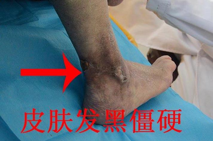糖尿病进入恶化期是什么症状