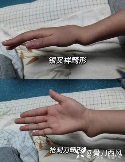 手部常见的五种畸形