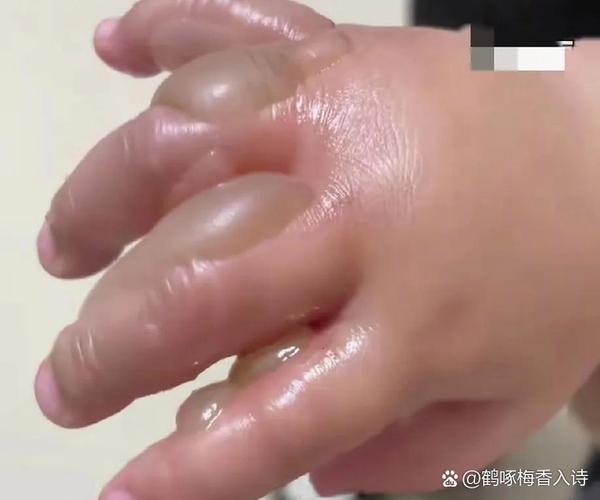 人被仓鼠咬了怎么办