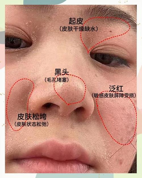 脸特别干燥起皮还刺痛怎么办
