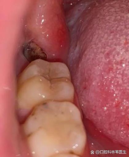 拔智齿后吃饭残渣掉洞里