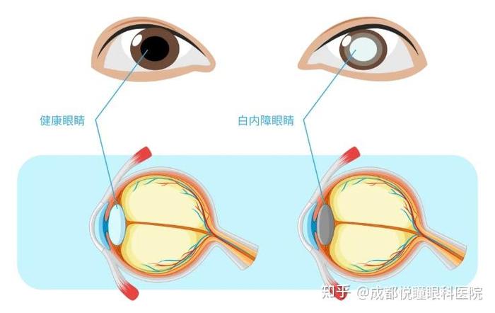 眼睛雾怎么办