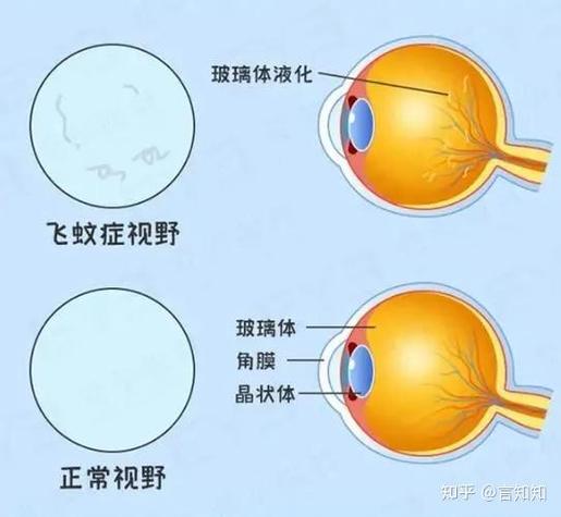 眼睛出现黑影飘动是什么原因