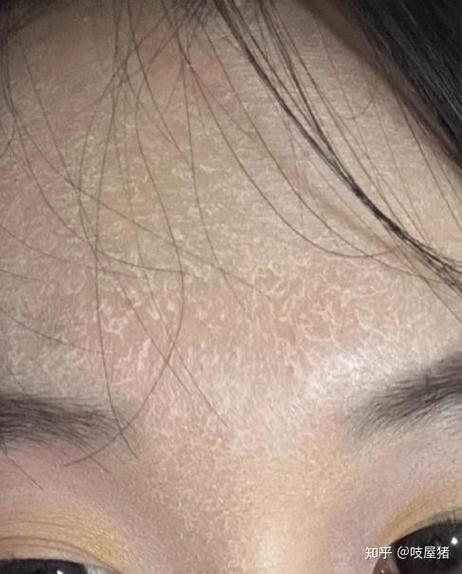 手环戴久了皮肤皱皮