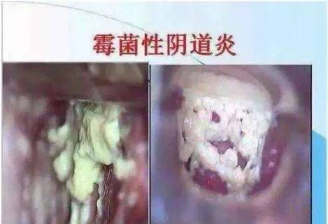 女性白色念珠菌是什么引起的
