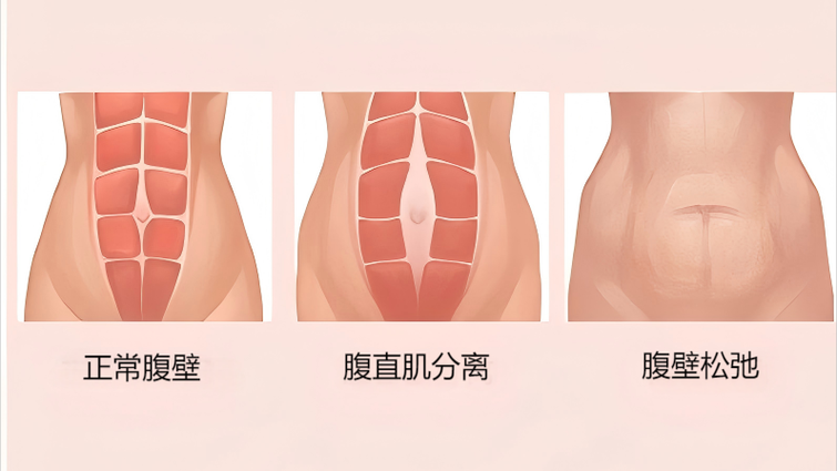 下垂的肚子能收紧吗