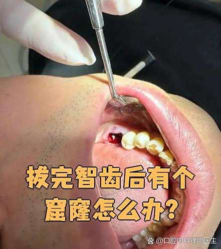 智齿有洞是补还是拔